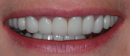 dental implants northern ireland