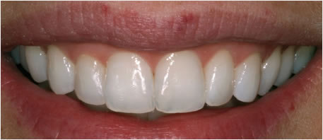 tooth whitening northern ireland